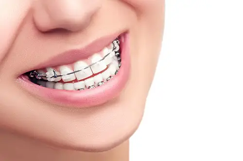 Common Questions About Dental Braces