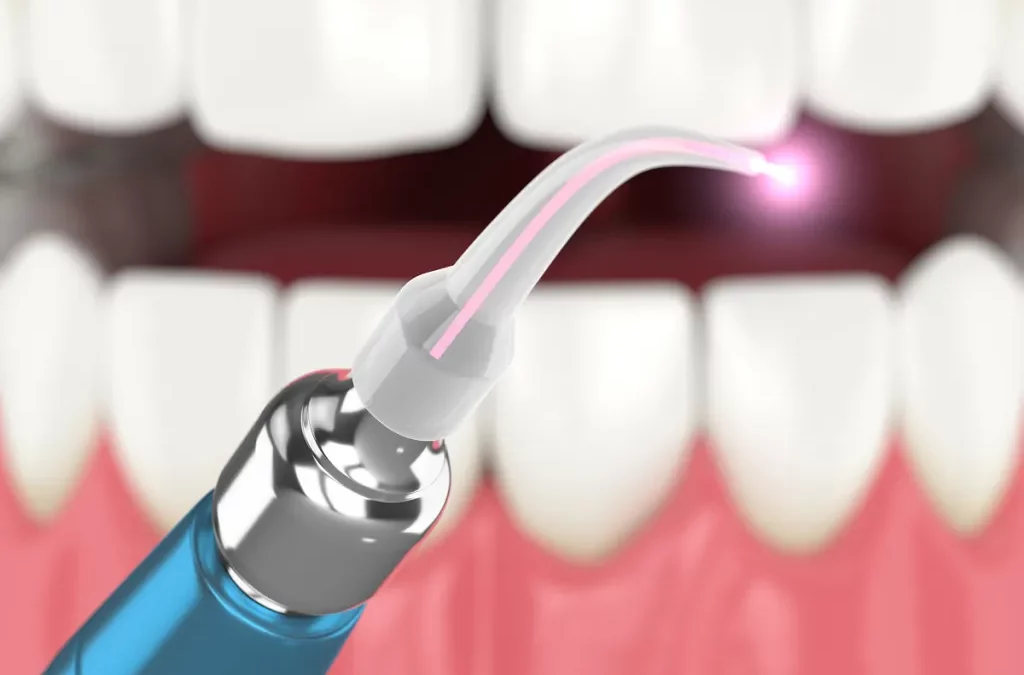 How Lasers Are Transforming Restorative Dentistry