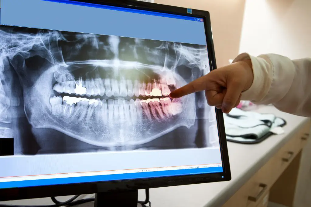 How to Eat After Oral Surgery