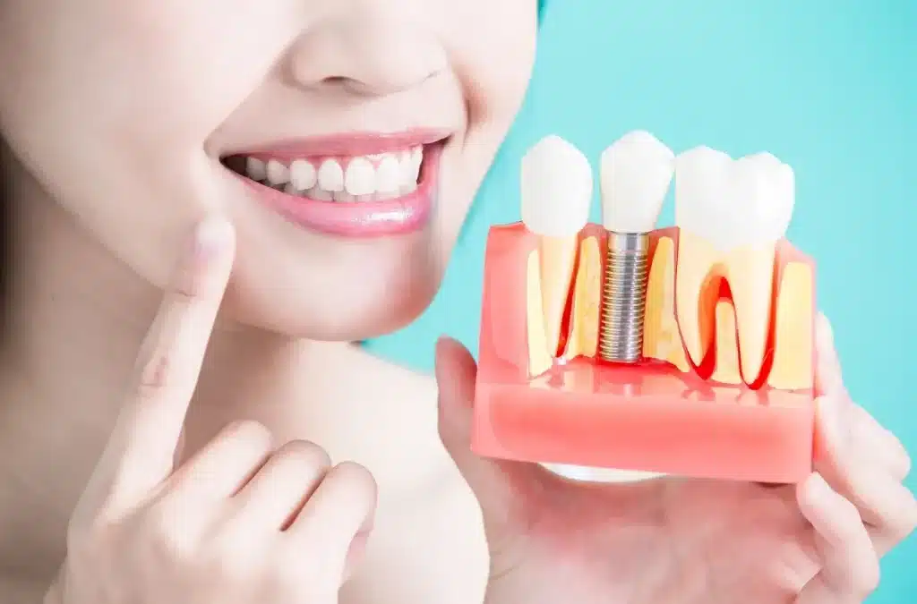 What to Expect With Dental Implants